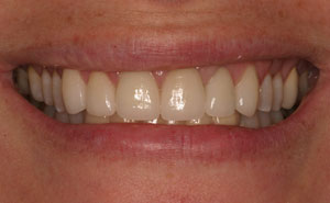 Closeup of flawless white teeth