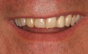 Closeup of damaged smile