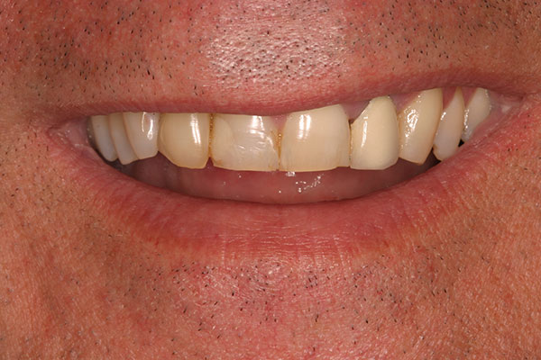 Closeup of damaged smile