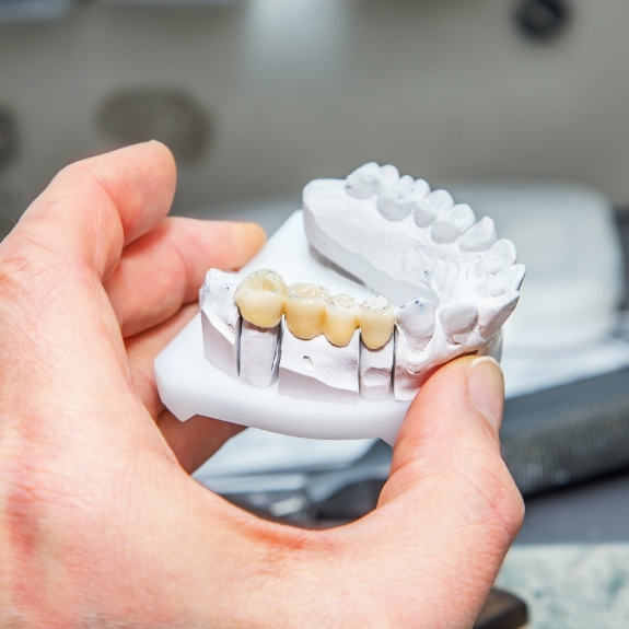 Hand holding a model of the mouth with a dnetal bridge covering three teeth
