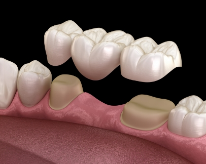 Illustration of a dental bridge being placed over two teeth to fill the gap between them