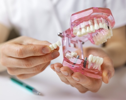 Dentist placing a dental bridge over two dental implants in a model of the mouth