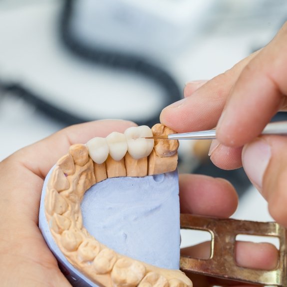 Dentist adjusting a dental bridge in a model of the mouth