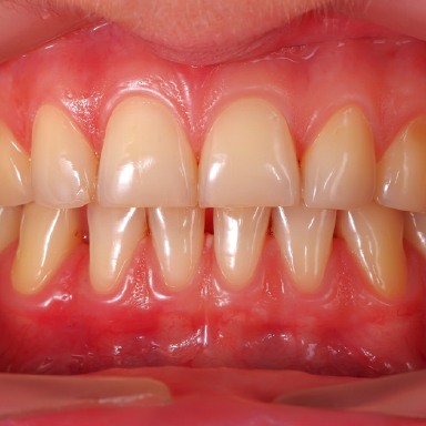 Healthy gums