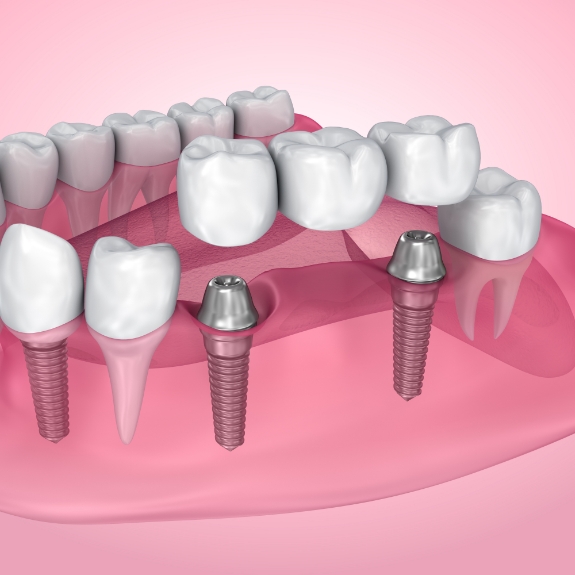 Illustration of a dental bridge being placed over two dental implants to replace three missing teeth