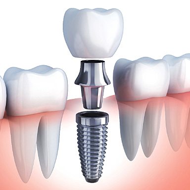 A dental patient wondering who the best Long Island Dental Implant Dentist is