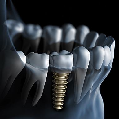 A happy Massapequa Park woman smiling and pointing to her new dental implant