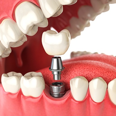 Animation of implant supported crown