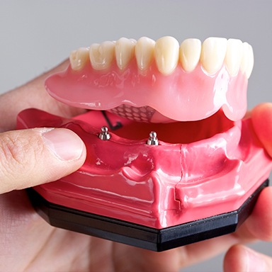 Model of implant retained dentures