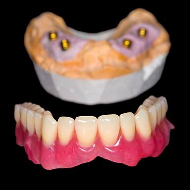 Model of All-on-4 implant denture