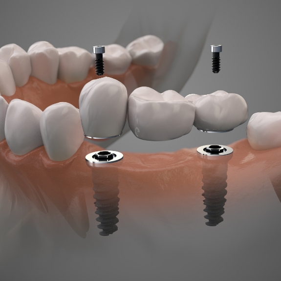 Illustration of two dental implants supporting a dental bridge to replace three consecutive missing teeth