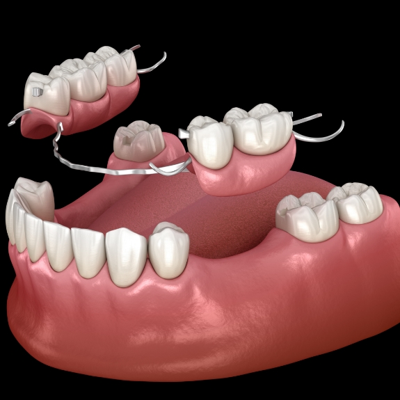 Illustration of a partial denture replacing several missing teeth throughout an arch