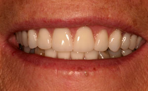 Closeup of flawless smile with cosmetic dentures