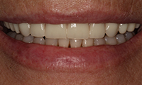 Closeup of patient with cosmetic dentures