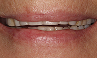 Closeup of patient with traditional dentures