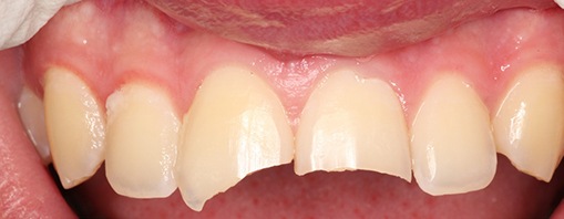 Smile with chipped teeth before treatment