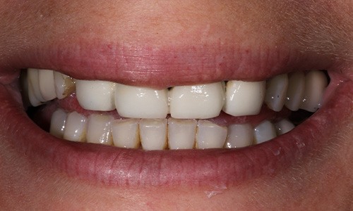 Senior female patient closeup before makeover