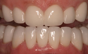 Closeup of perfectly healthy bottom teeth