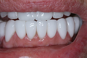 Closeup flawlessly repaired smile after implants