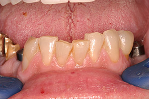 Closeup front teeth with implants visible