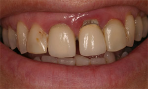 Closeup of damaged smile