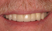 Senior man patient closeup after full mouth reconstruction