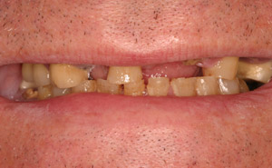 Closeup woman's damaged smile before treatment