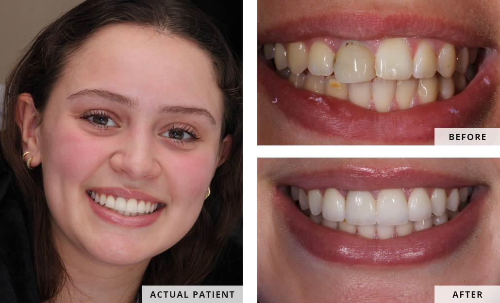 before and after