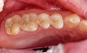 Two teeth with tooth colored fillings