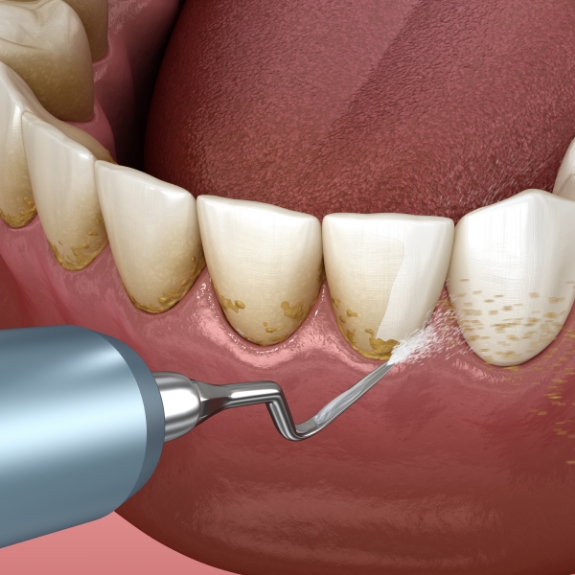Illustration of a dental scaler clearing tartar buildup from the teeth and gums