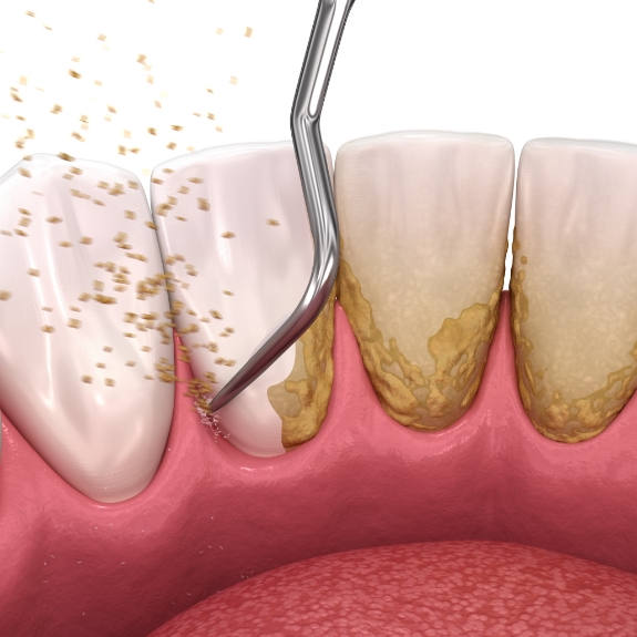 Illustration of a dental scaler removing tartar buildup from the gumline