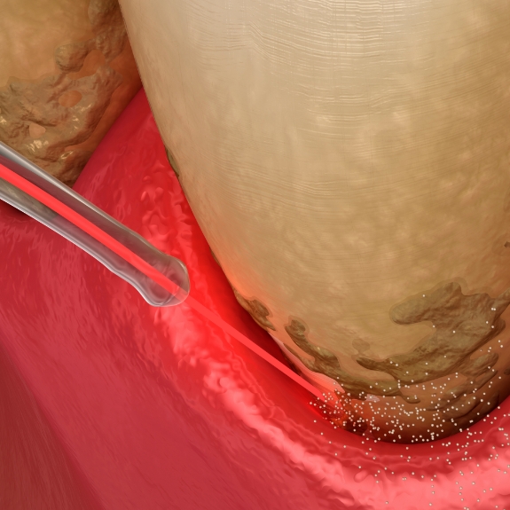Illustration of a dental laser removing tartar buildup from the gumline