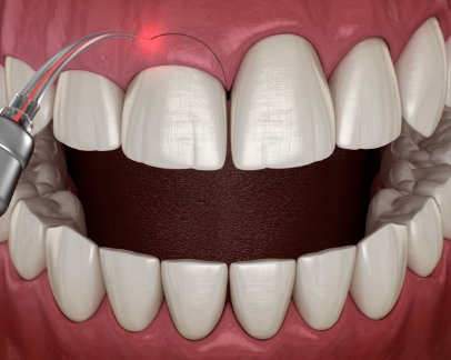 Illustration of a dental laser removing excess gum tissue