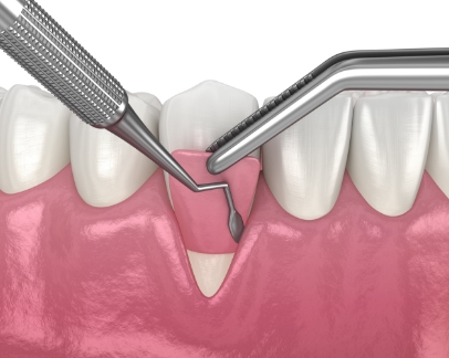 Illustration of soft tissue being applied in front of a tooth with receding gums