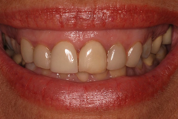 Closeup of gummy smile