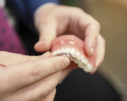 Dentist placing a clear aligner over a model of a row of teeth