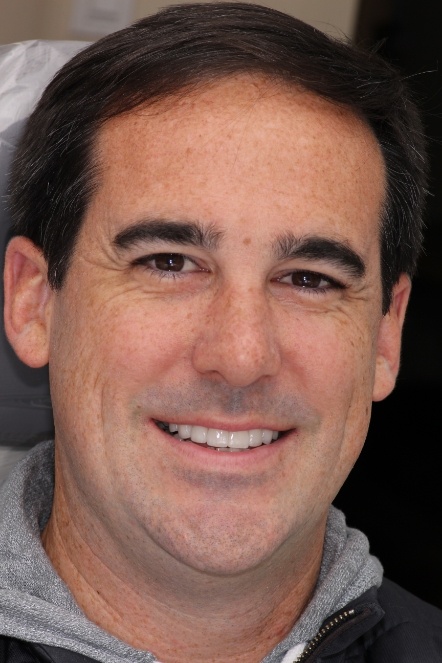Hurley after having smile improved with veneers