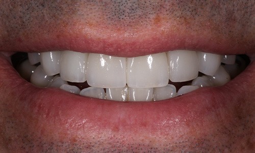 Close-up of complete smile with alignment corrected