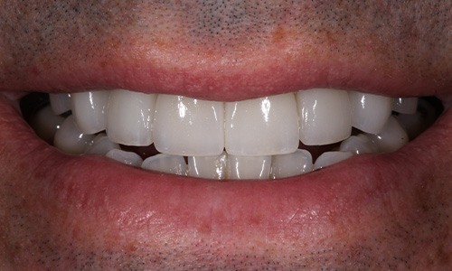 Closeup of Mike after Long Island veneers