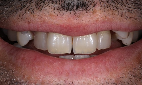 Close-up of smile with missing and badly aligned teeth