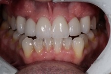 Closeup of Mike after Long Island veneers