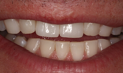 Closeup man with replaced front teeth  after implants