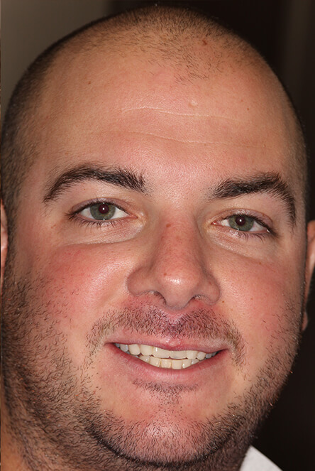 Man with replaced front teeth after implants