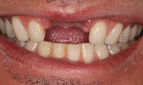 Closeup man with missing front teeth before implants