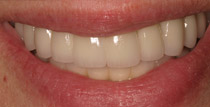 Cloeup of implant denture front