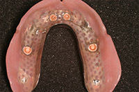Inisde of implant denture
