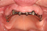 Gums with implant denture appliance in place