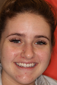 Young girl with replaced teeth after implants