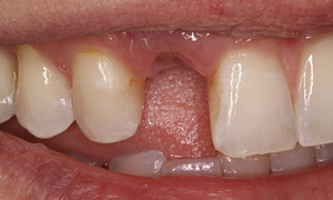 Missing tooth closeup before implants