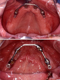 Top and bottom of mouth with implants in place
